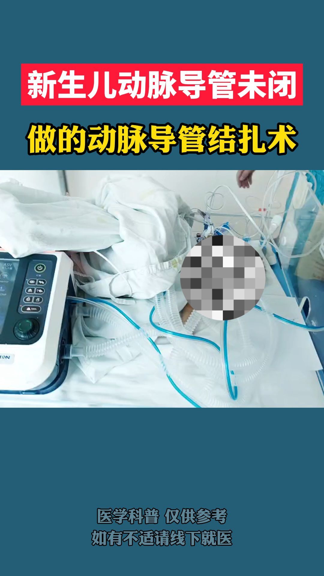 新生儿动脉导管未闭,做的动脉导管结扎术