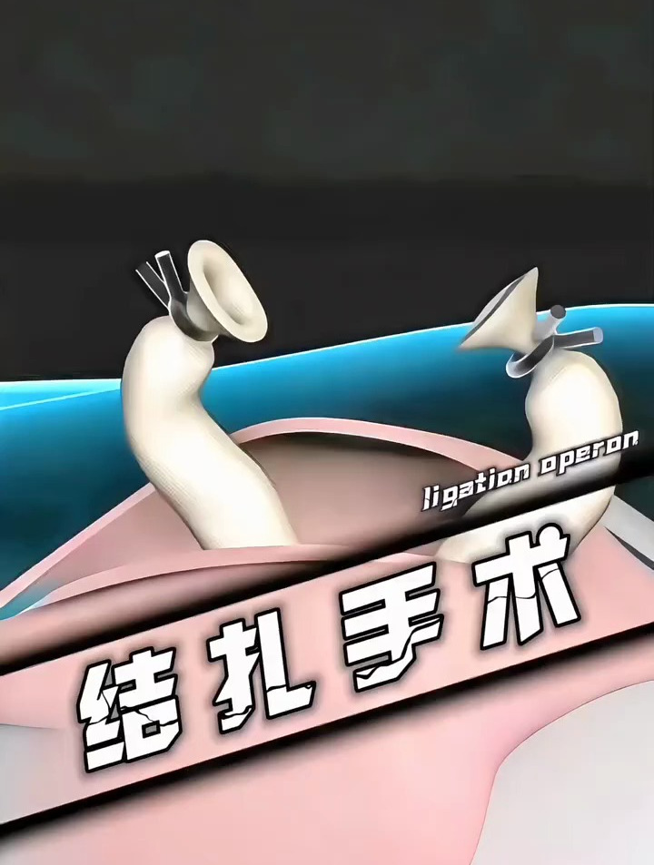 男性结扎手术究竟有多恐怖