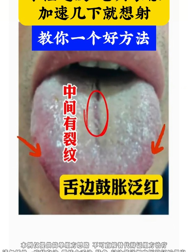 包含早泄该怎么挂号的词条