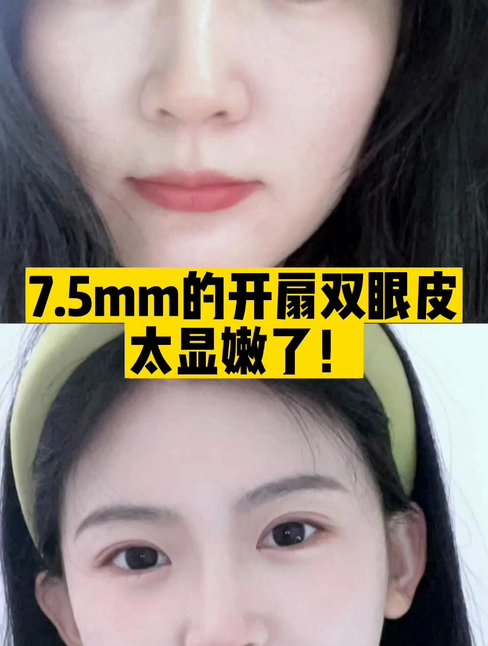 7.5mm的开扇双眼皮,太显嫩了