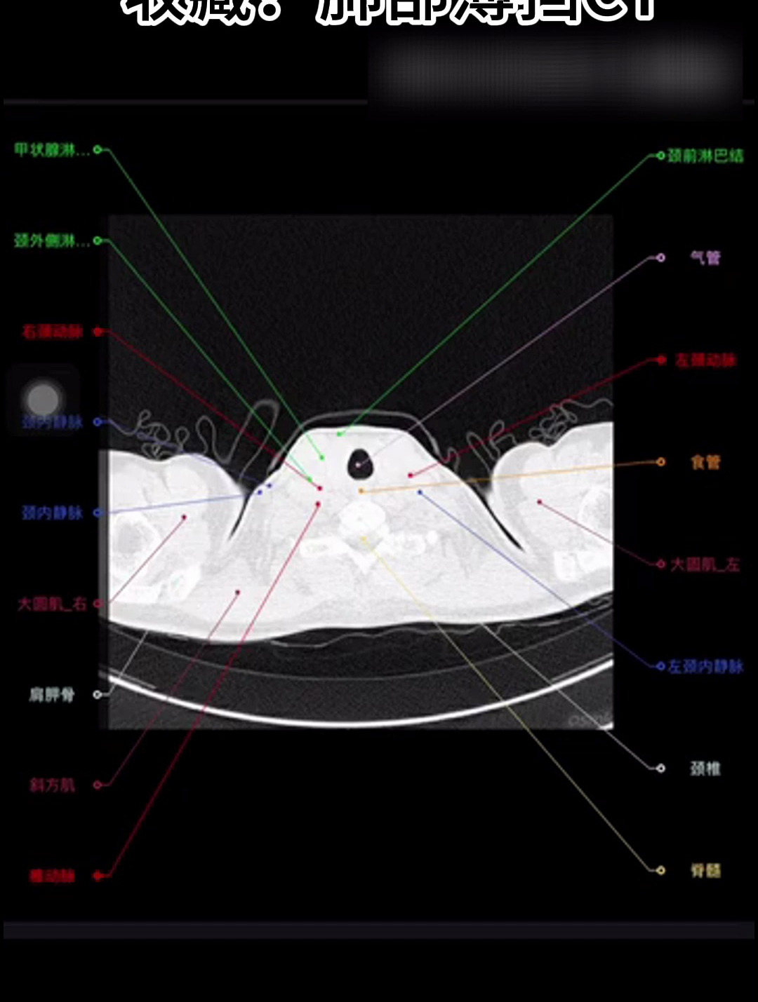 肺窗和纵隔窗区别图片图片