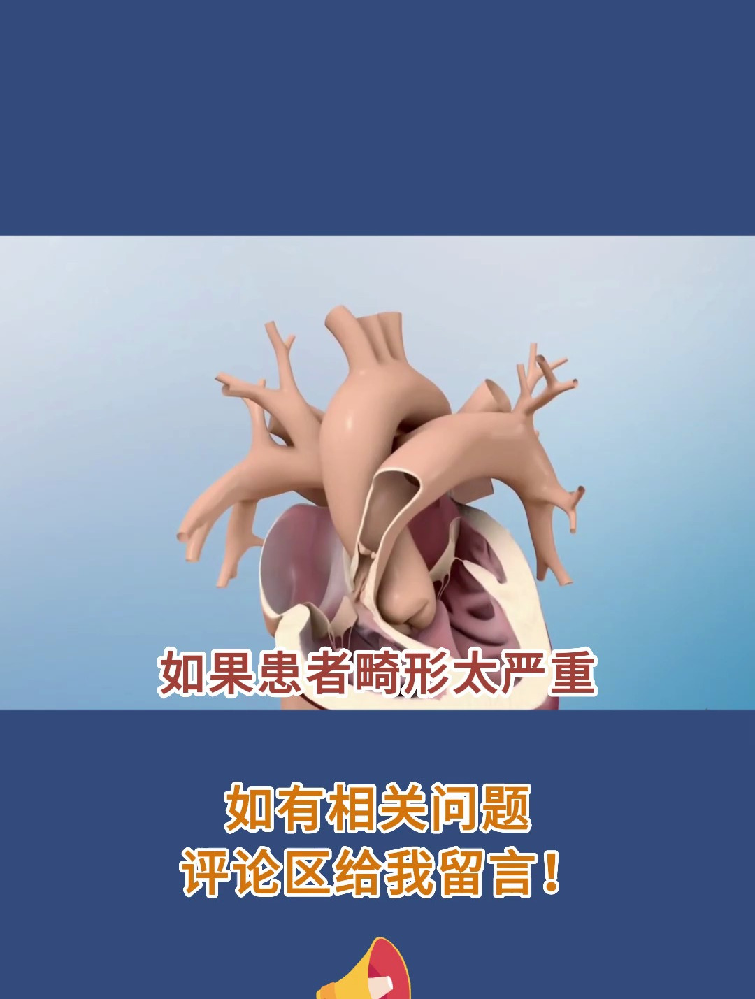 法洛四联症,3d手术过程