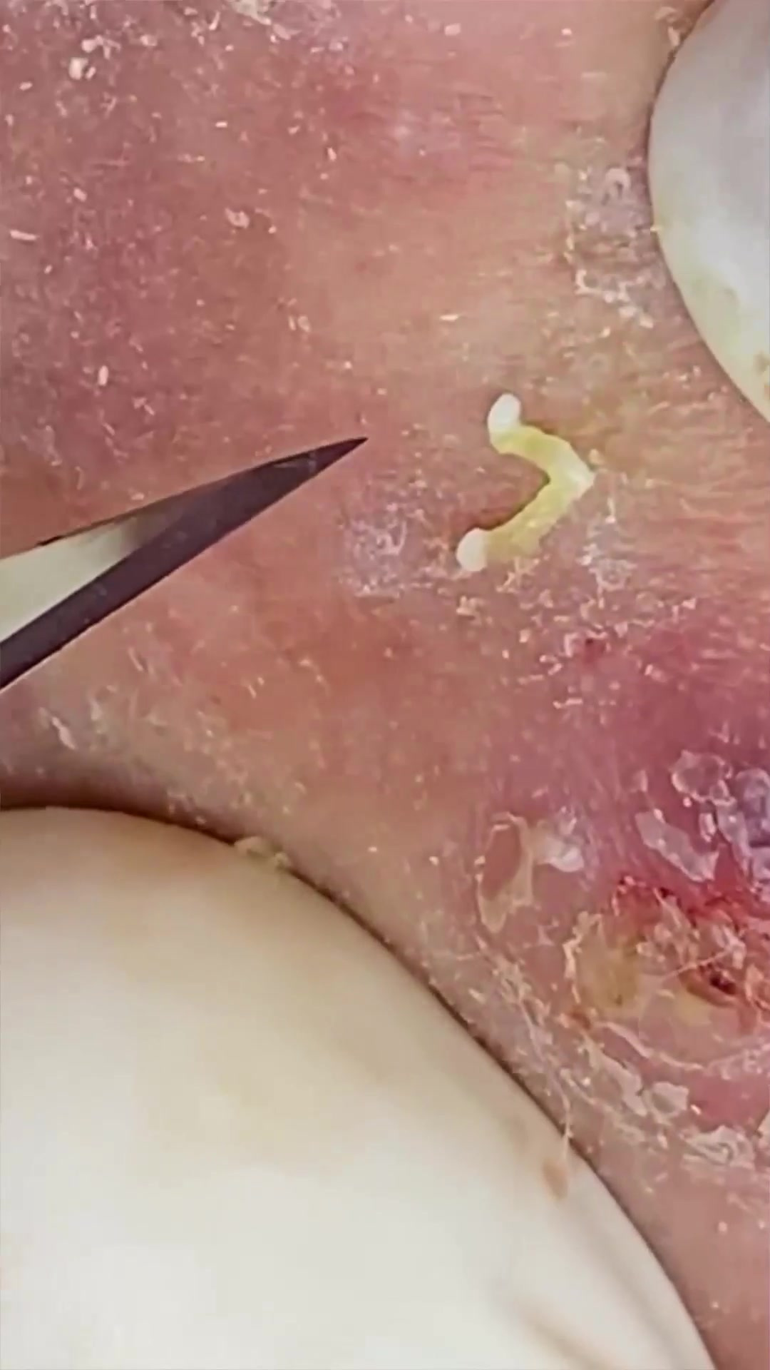 手挤痘痘黑头容易造成皮肤损伤,推荐大家使用这款工具