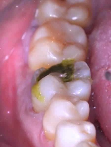 23岁小伙不注意护理牙齿,里面塞满了食物残渣,疼痛难忍-度小视