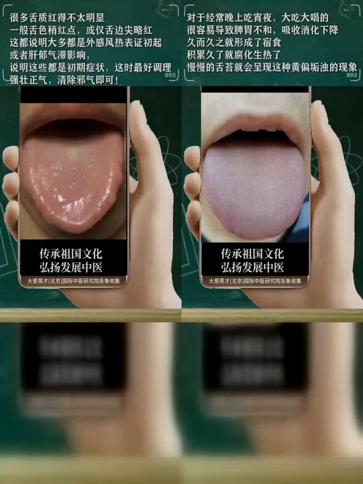 细品舌象:薄黄苔,二火不潜,神经衰弱,疏肝扶阳-度小视