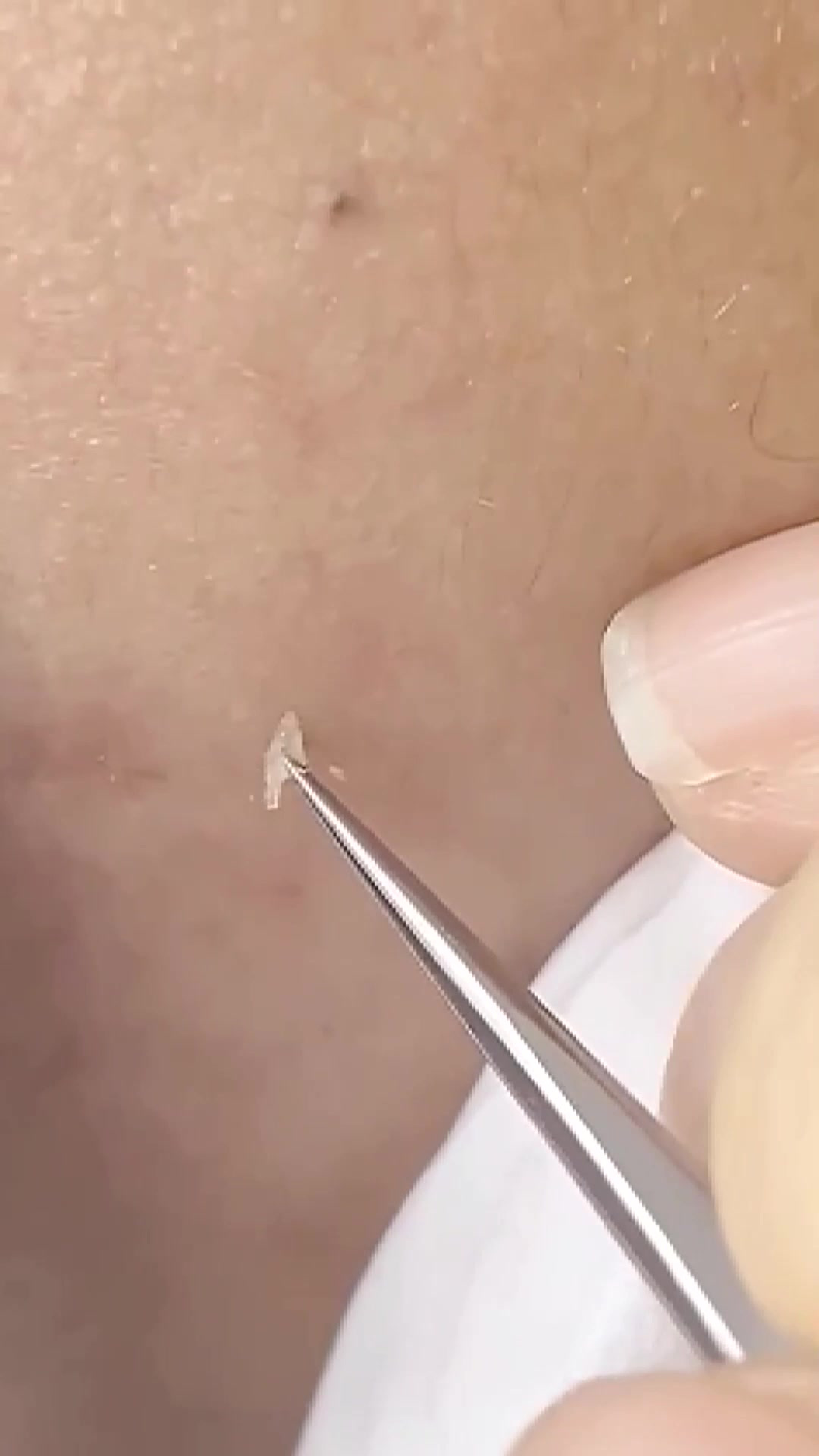 手挤痘痘黑头容易造成皮肤损伤,视频同款工具,赶紧来试试吧