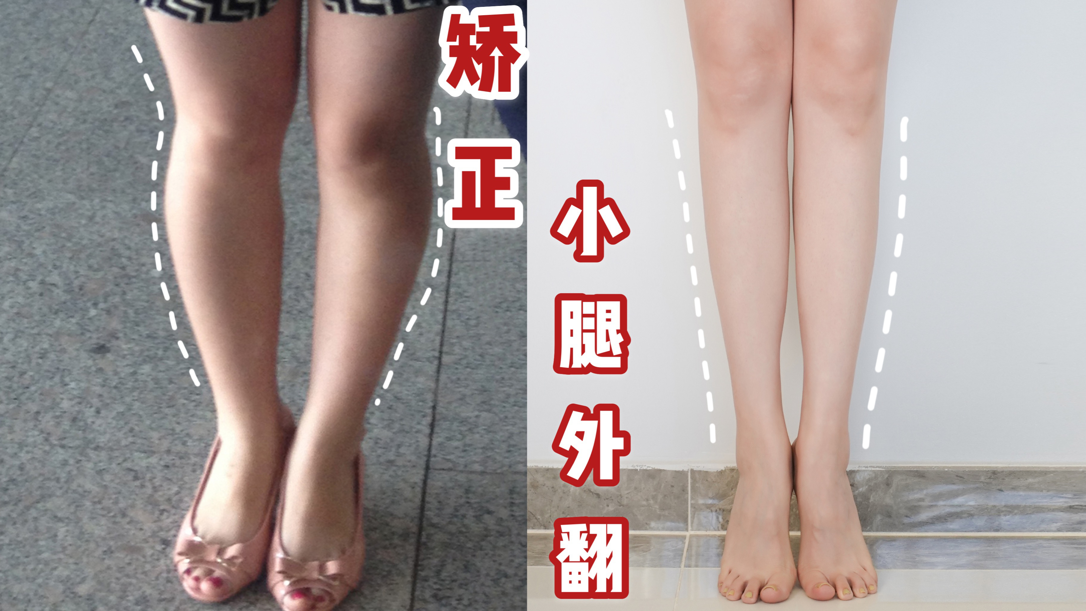 每天5分钟,改善小腿外翻、膝盖内侧突出!