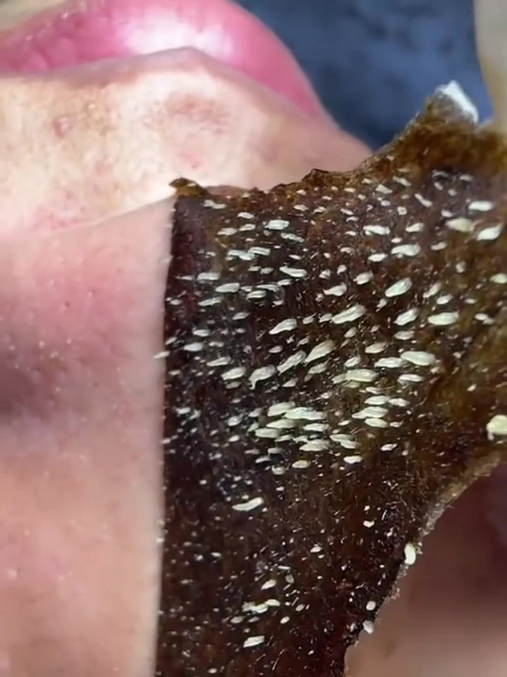 黑鼻头贴太厉害了,黑头粉刺一掀而起,拒绝草莓鼻