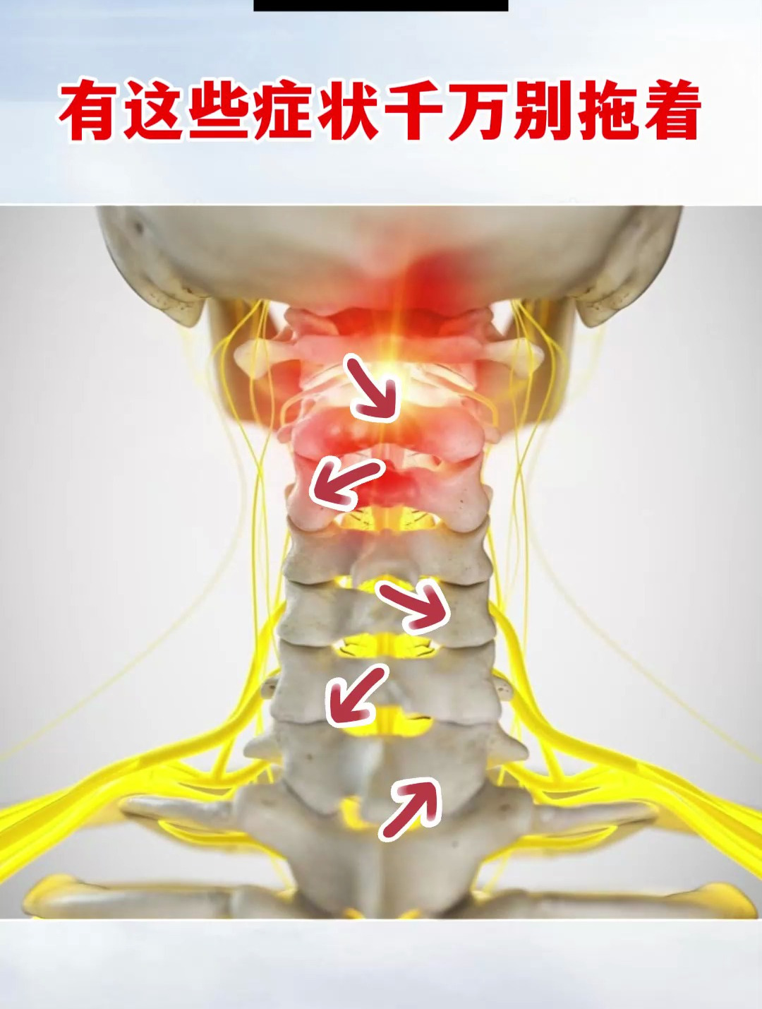 颈椎病有这些症状