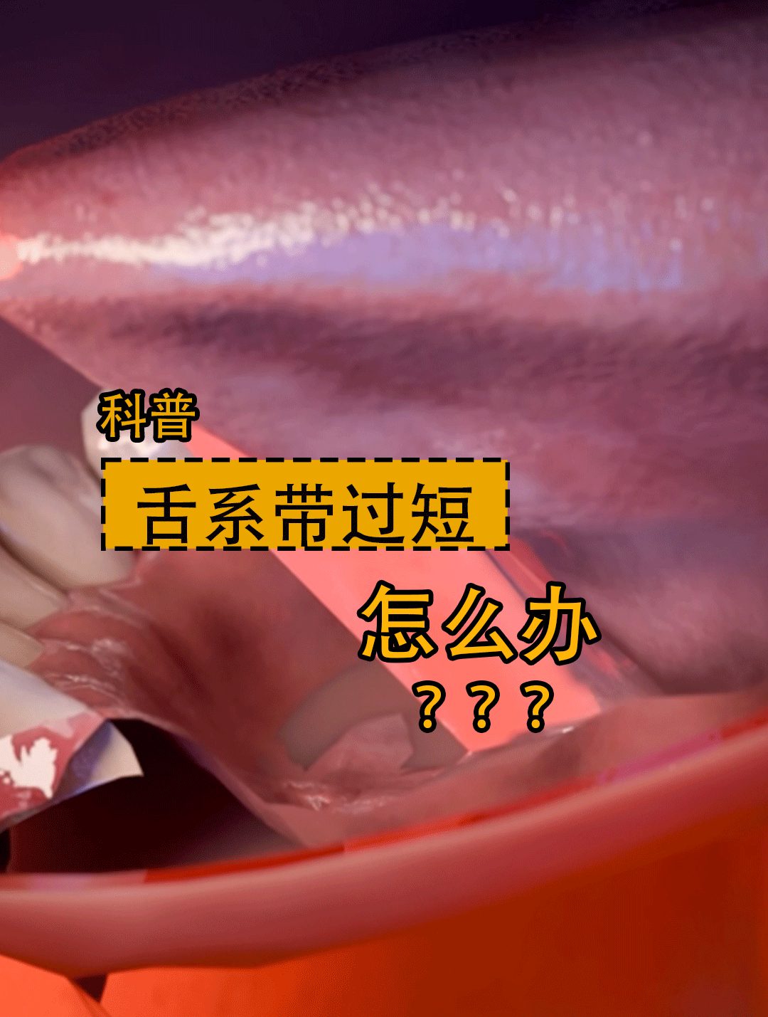 如果舌系带过短,会怎么样呢?悬雍垂过长,会给人带来什么影响呢