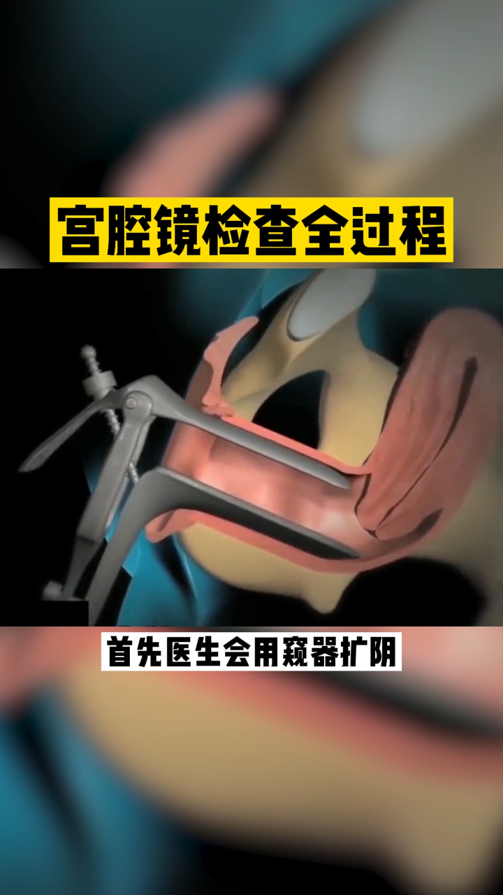 宫腔镜检查你看过吗看完后恍然大悟