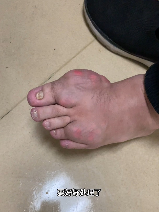 吃了非布司他,痛风石还会越来越大?