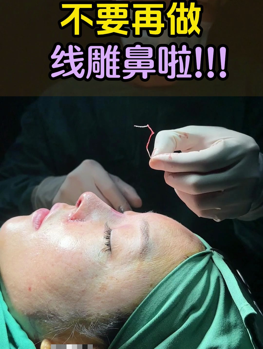 不要做线雕鼻了,美女取了十几根线出来