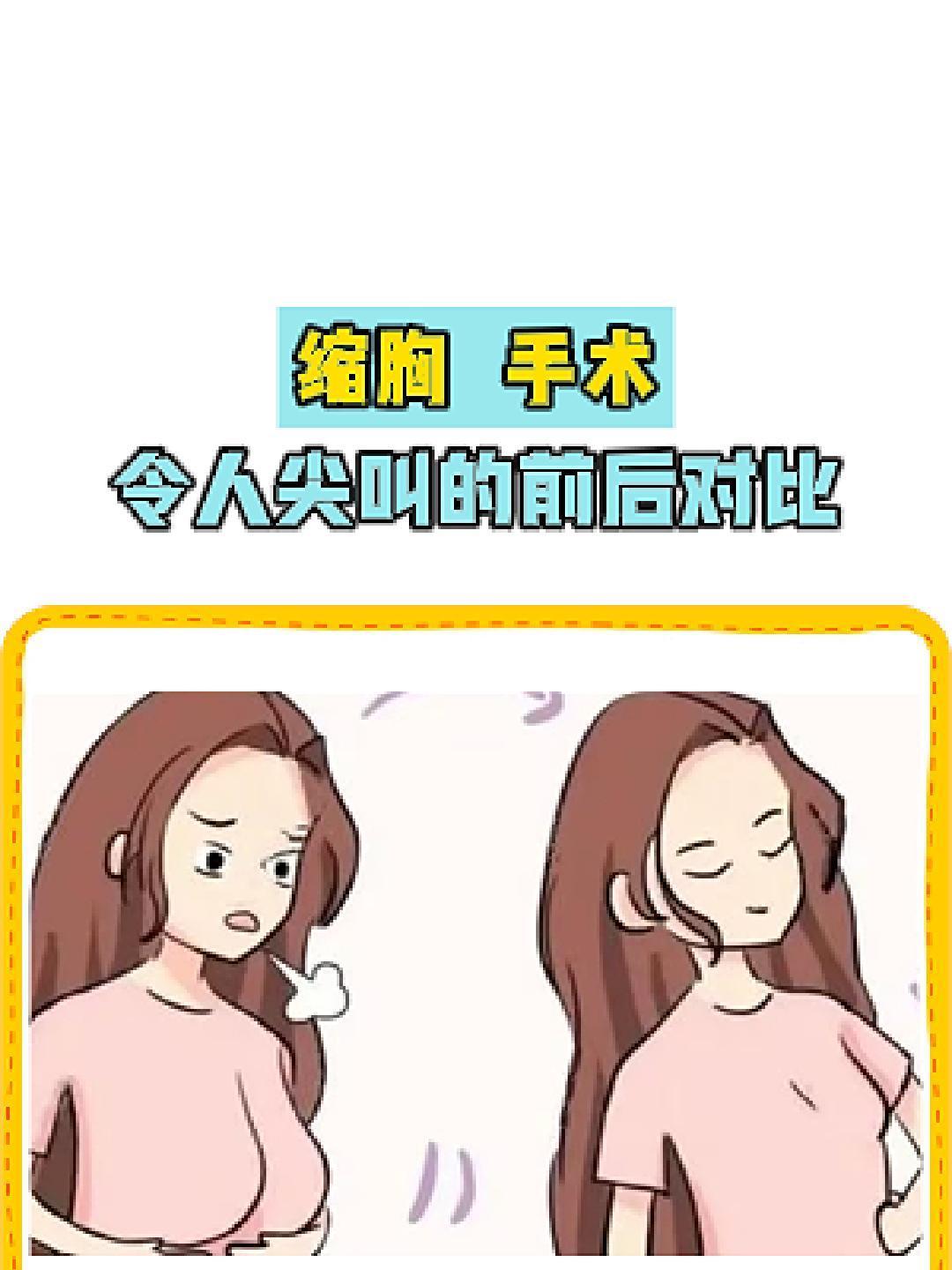 缩胸 胸部整形 陆洋医生