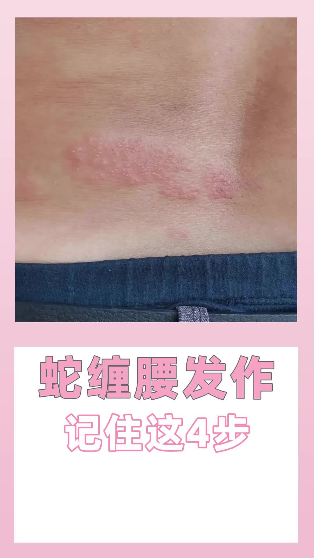 蛇缠腰前兆图片