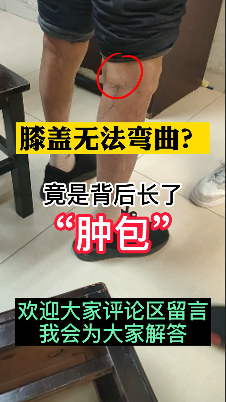 膝盖没办法弯曲出手一按才知道是长了囊肿