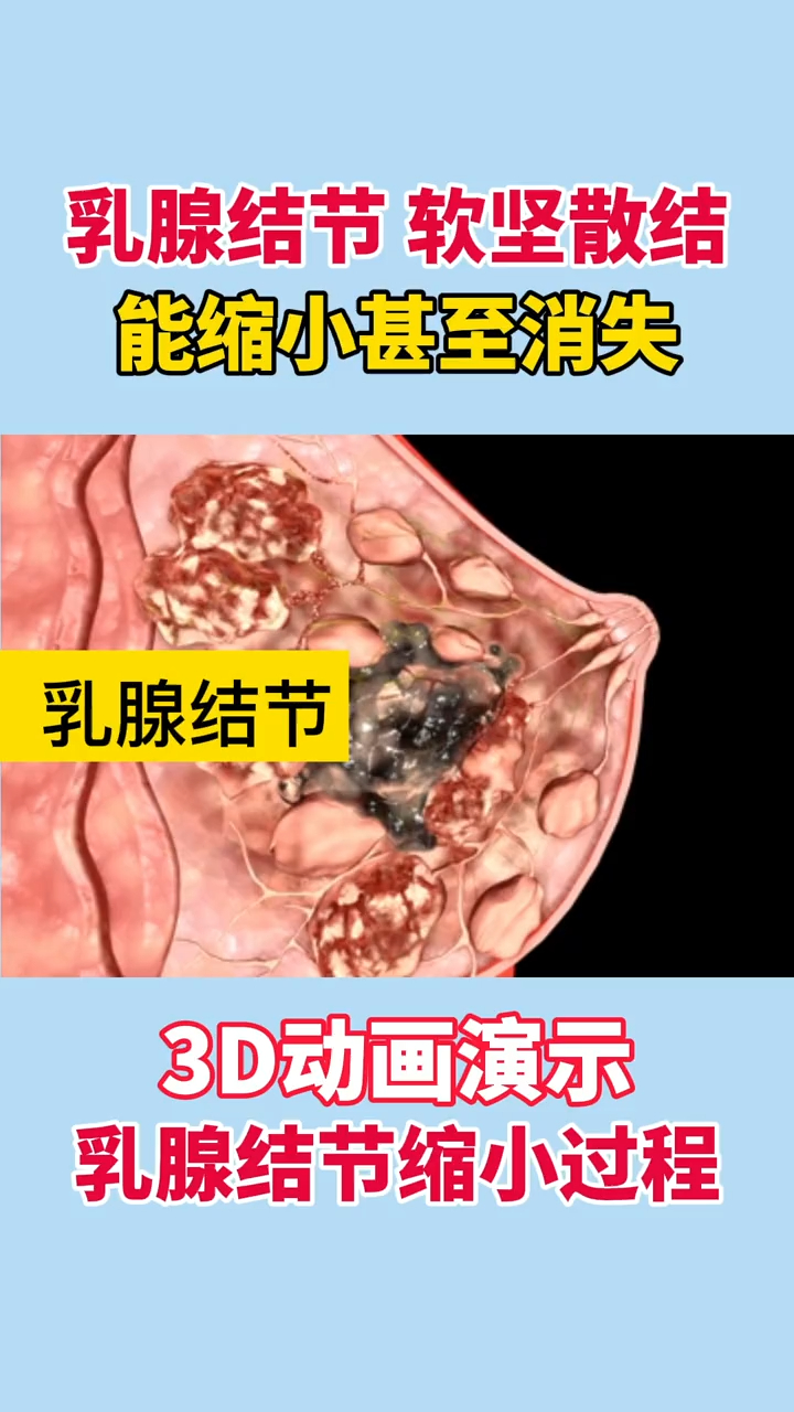 3d动画演示乳腺结节缩小过程