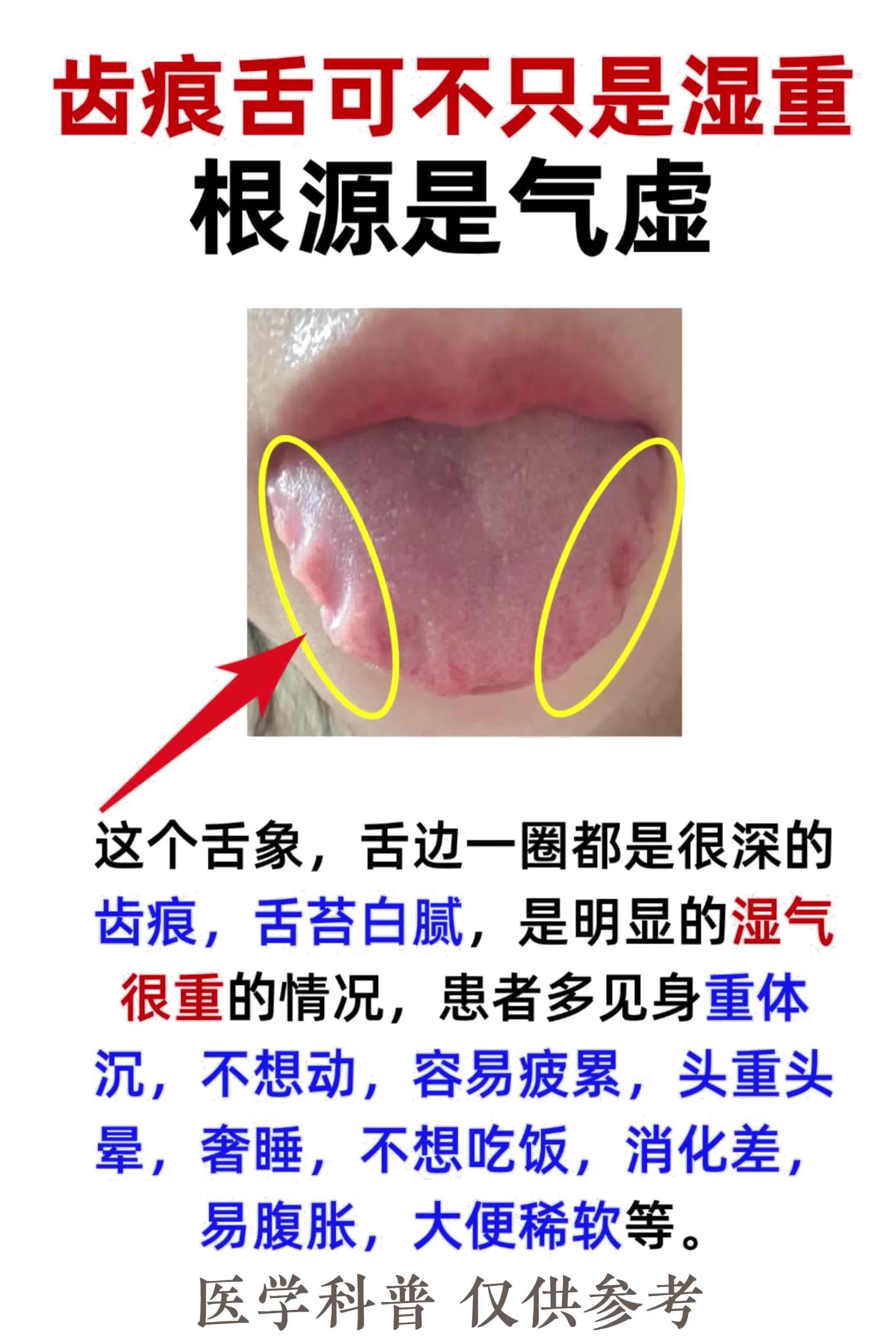 舌头有齿痕是怎么回事图片