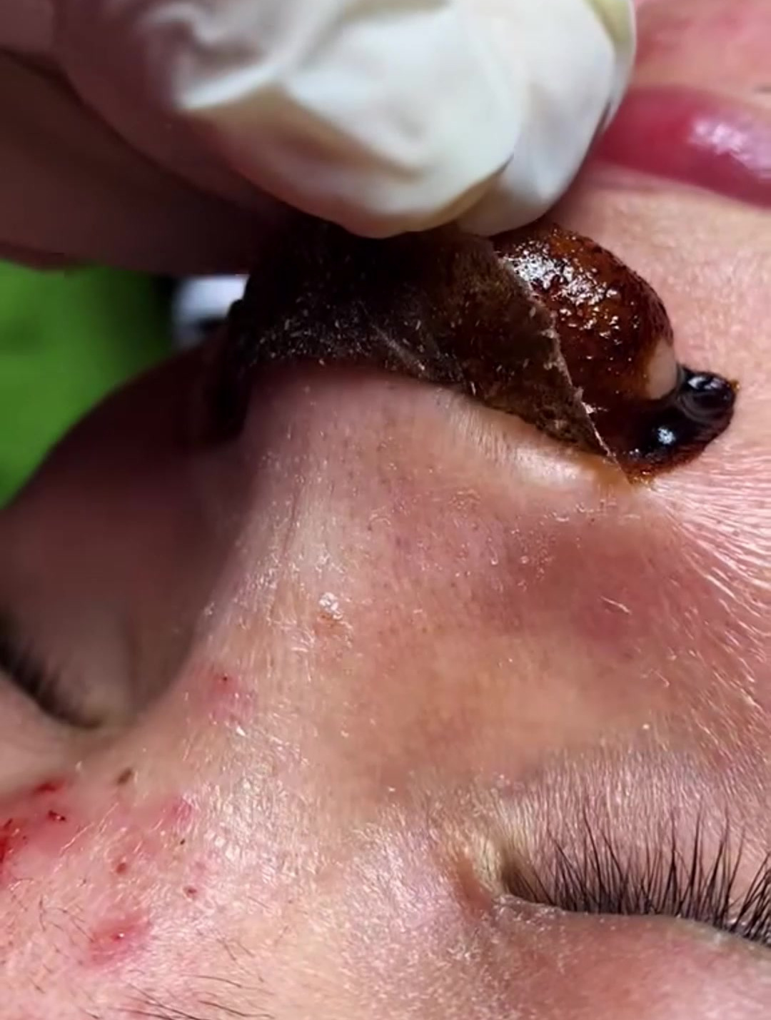 黑鼻头贴太厉害了,黑头粉刺一掀而起,拒绝草莓鼻