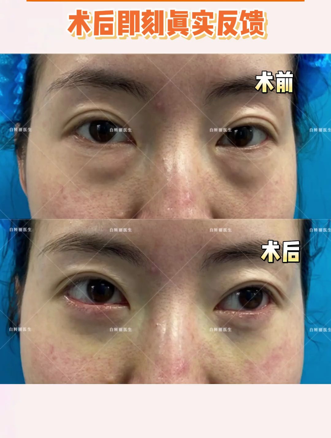 无痕祛眼袋术后即刻真实反馈!