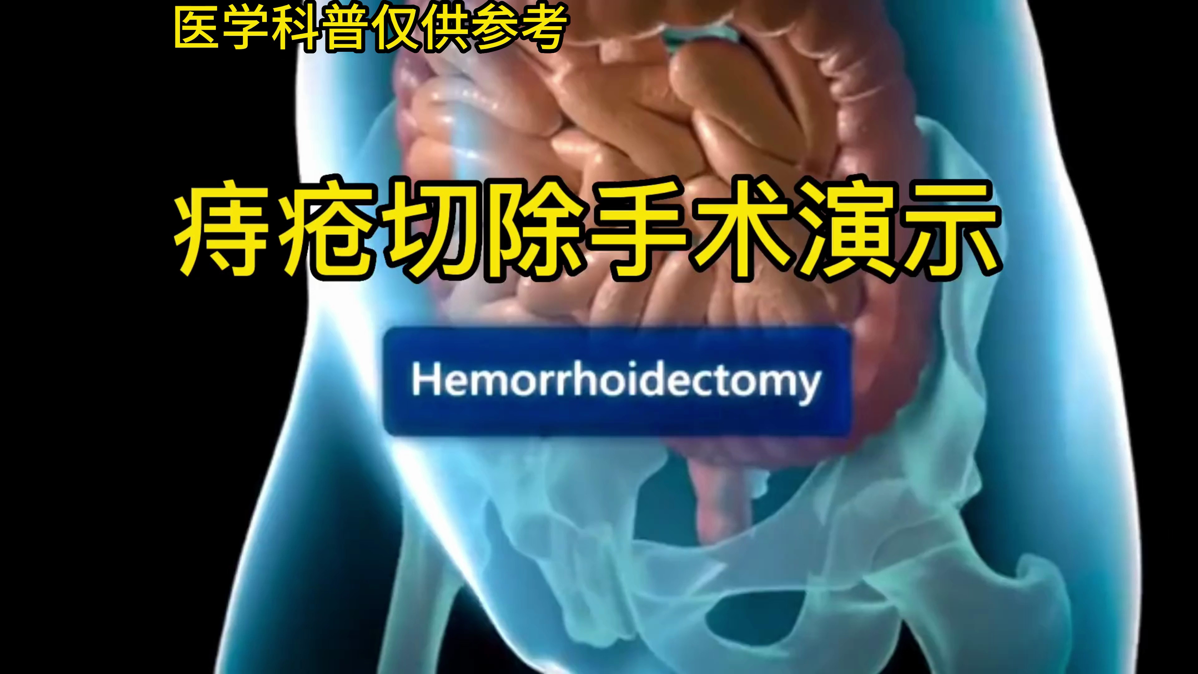 动画演示痔疮切除手术,看看你是几度痔疮,医学科普仅供参考