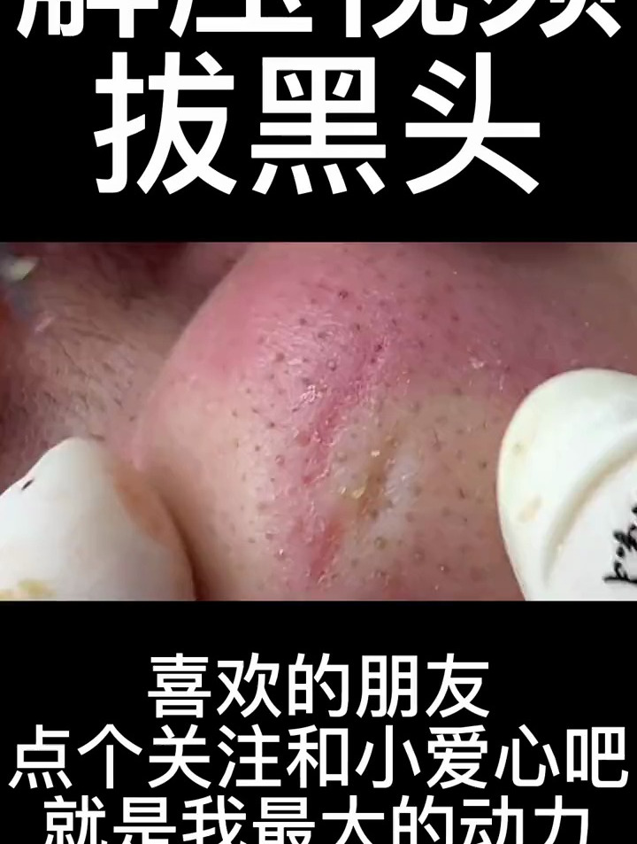 痘痘黑頭粉刺拜拜 強迫症看了很享受 解壓視頻 深層毛孔清潔