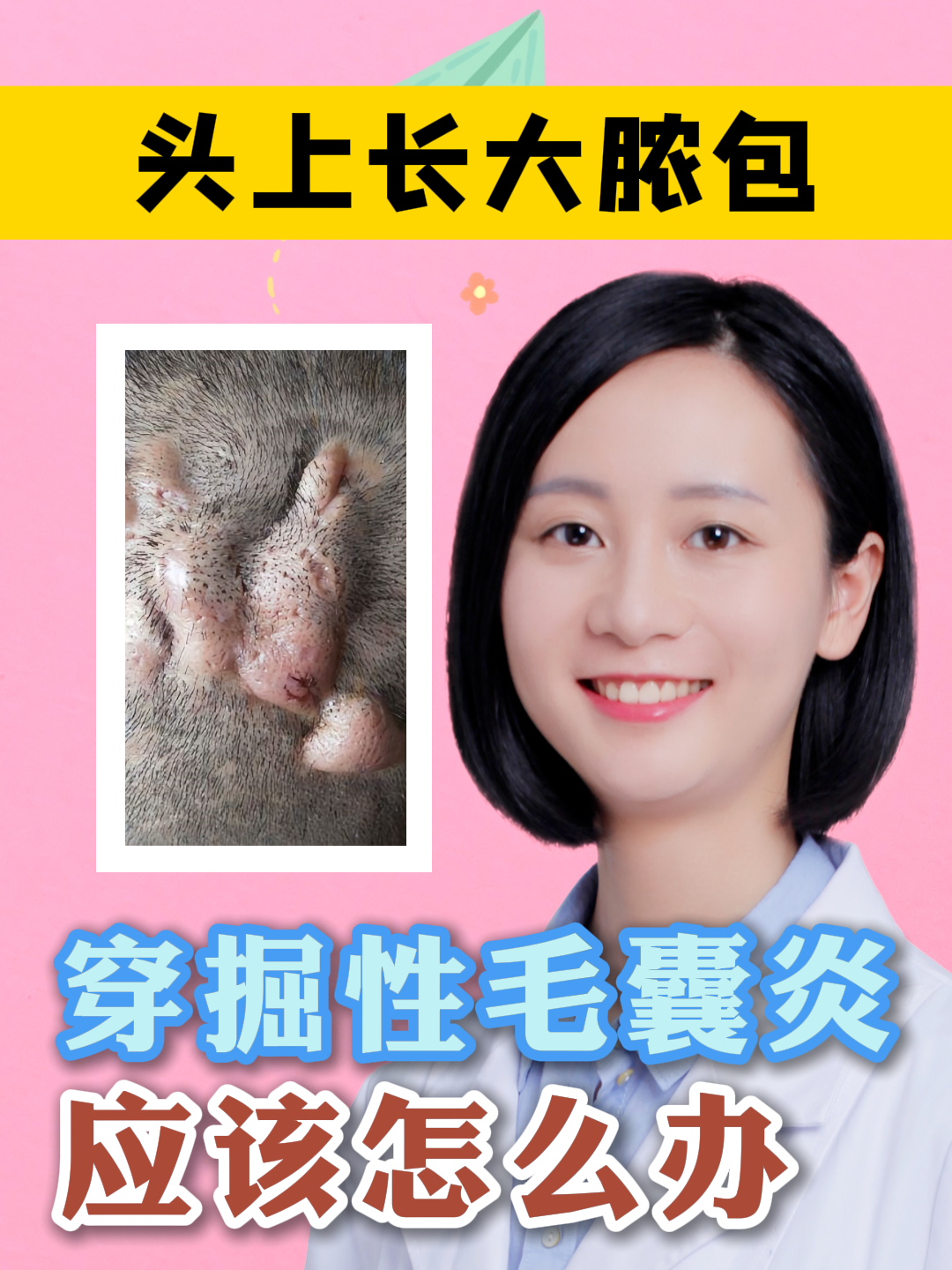 头上长大脓包 又肿又痛 穿掘性毛囊炎怎么办?