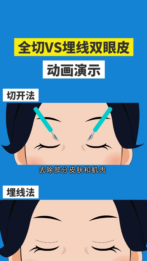 动画演示埋线双眼皮和切开双眼皮手术全过程