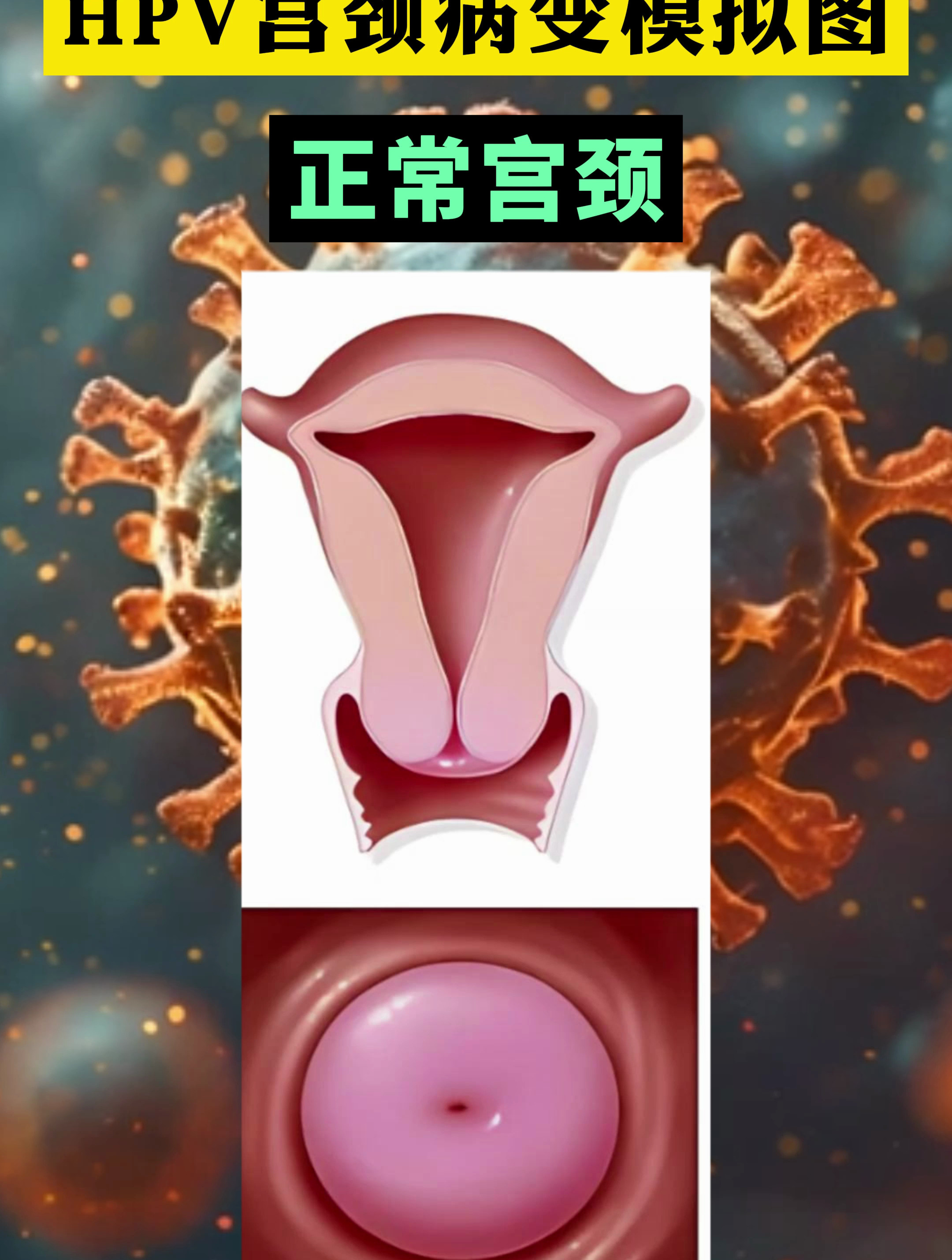 hpv宫颈病变模拟图