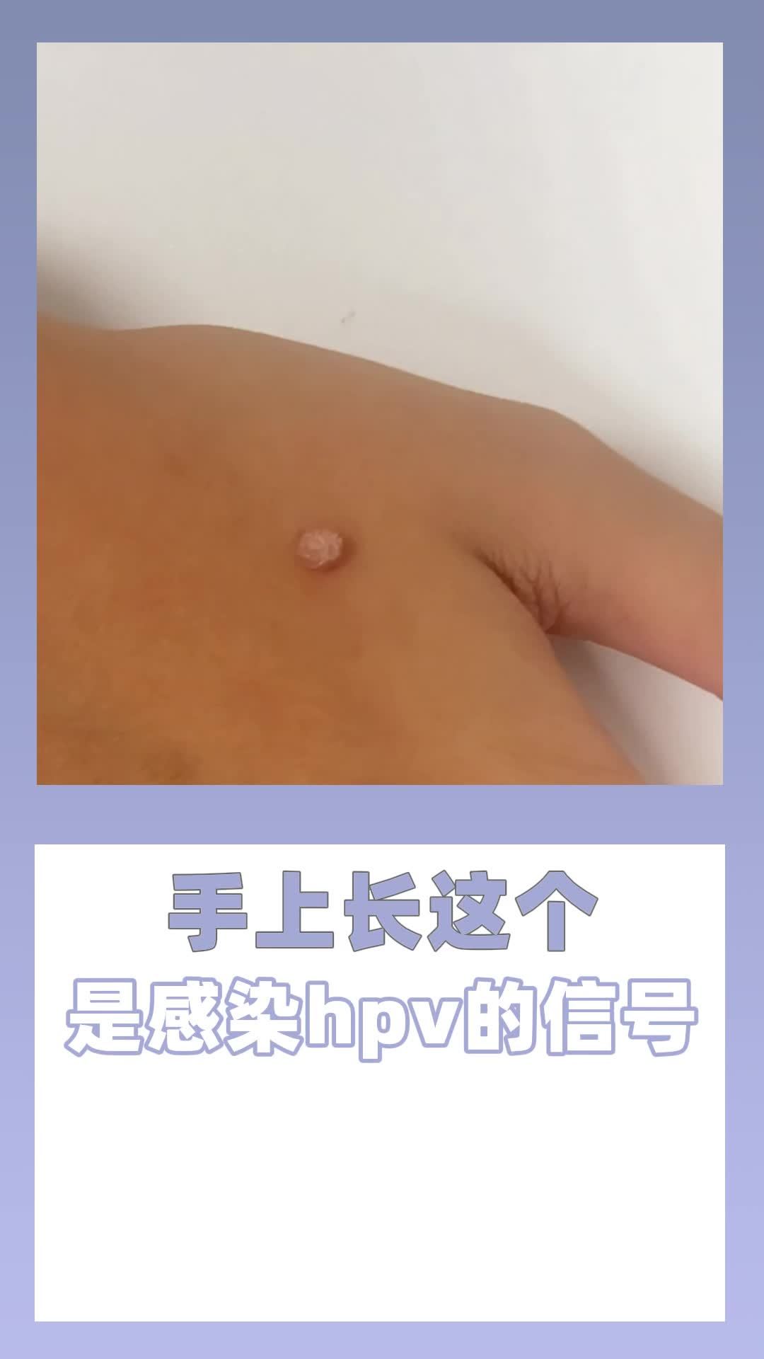5.24 手上长这个 是感染hpv的信号(1)