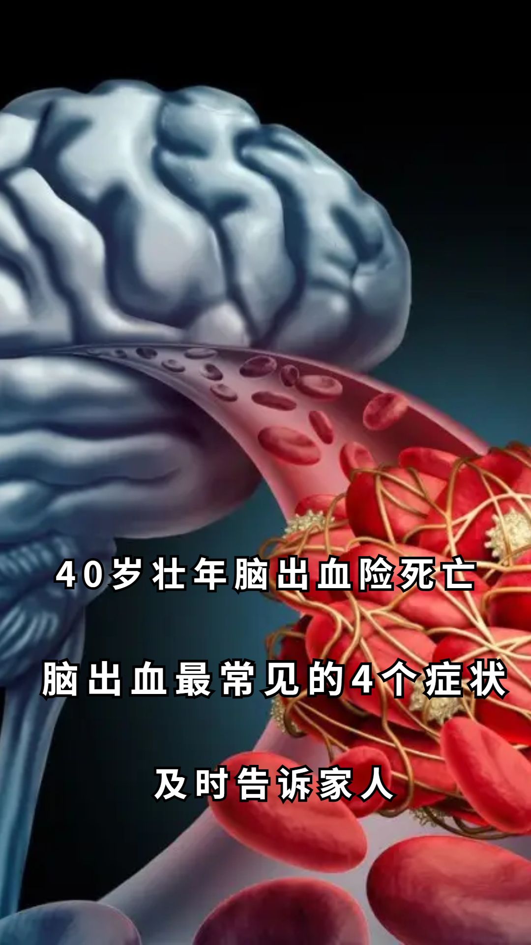 40歲壯年腦出血險死亡腦出血最常見的4個症狀及時告訴家人