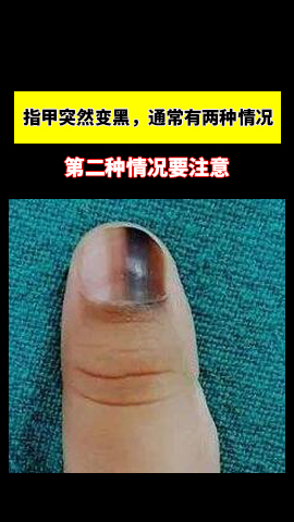 指甲突然变黑通常有两种情况第二种情况尤其要注意
