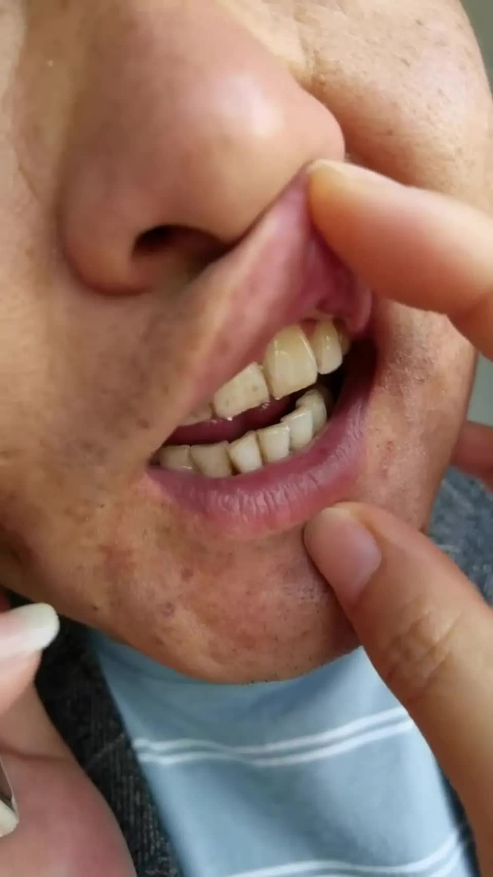 一天一包槟榔的下场,牙齿变成这样,还有女生喜欢吗!-度小视