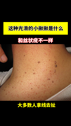 这种光滑的小揪揪叫作皮赘和丝状疣不一样