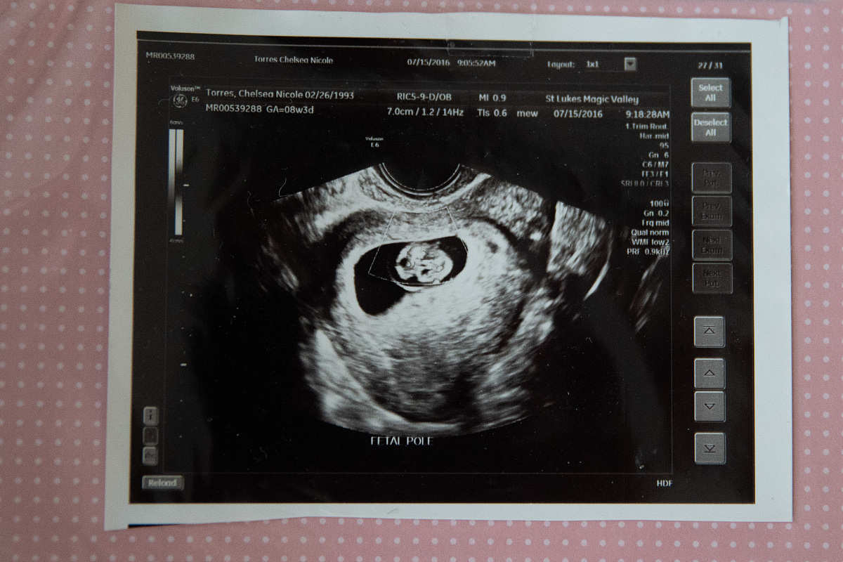 在b超检查中,医生更注重救焉锬 男宝孕囊形状图片已生男孩孕囊图片