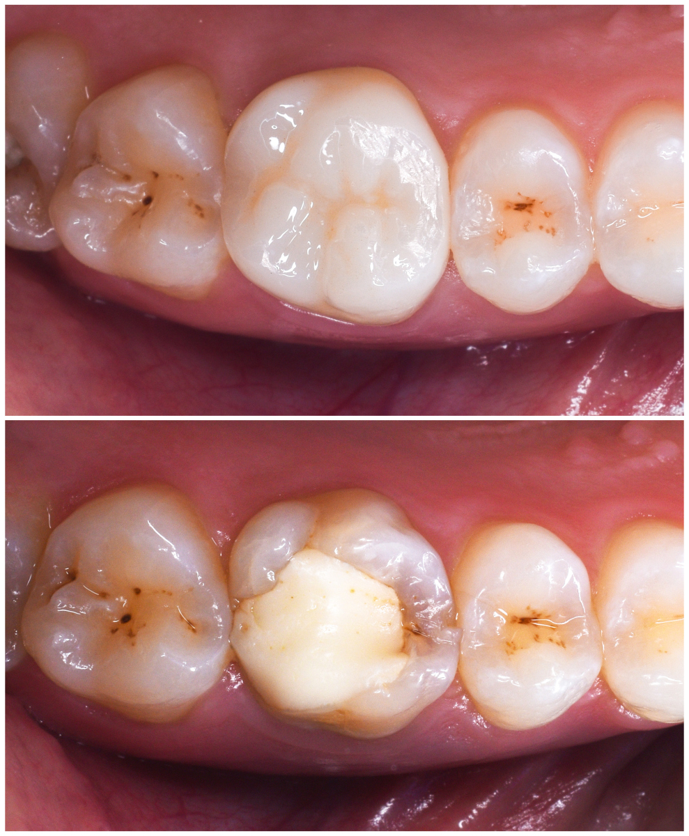 牙齿能补,那就别根管治疗.