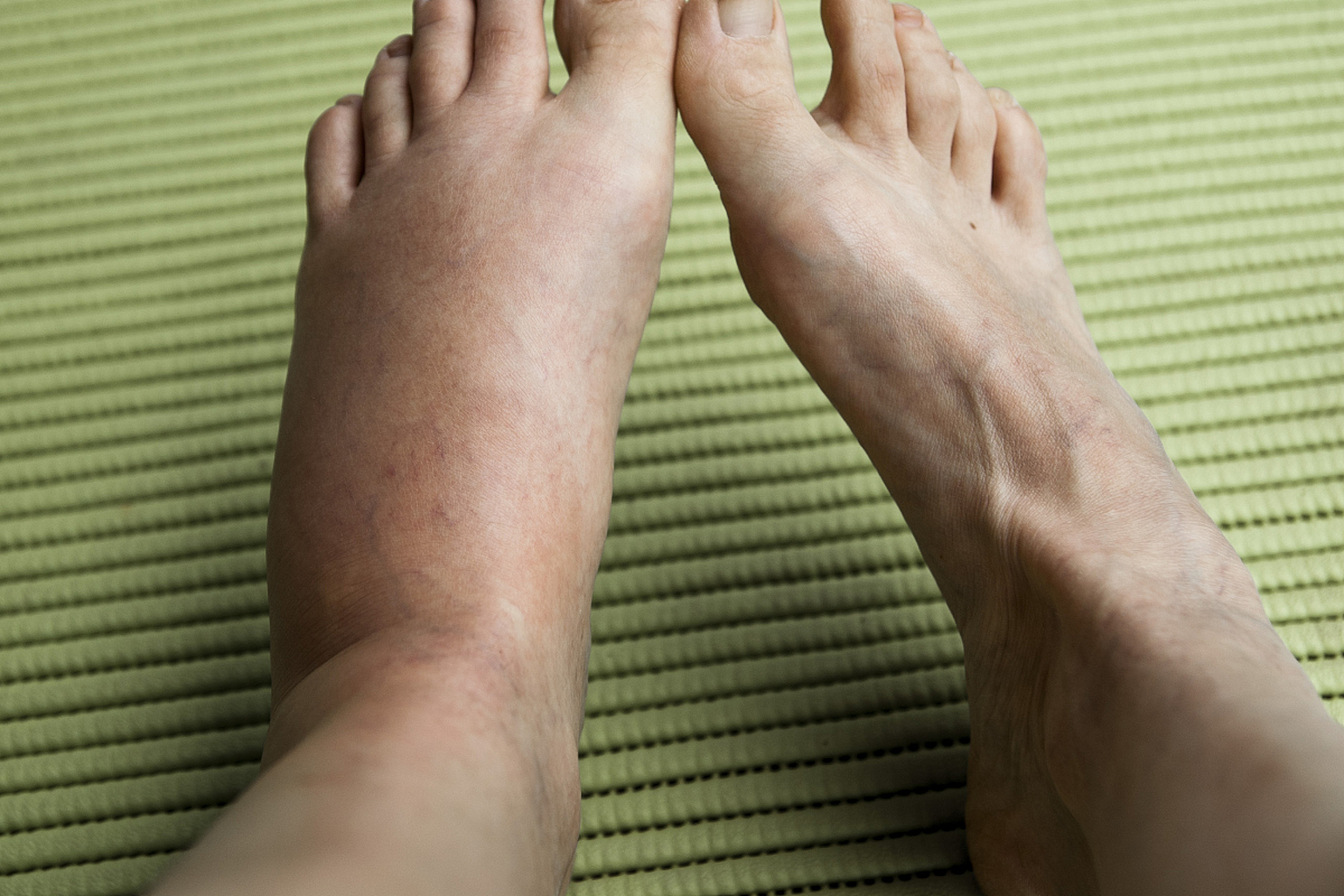 第二阶段:眼睑跟足部同时出现浮肿,三五天才能消一点.