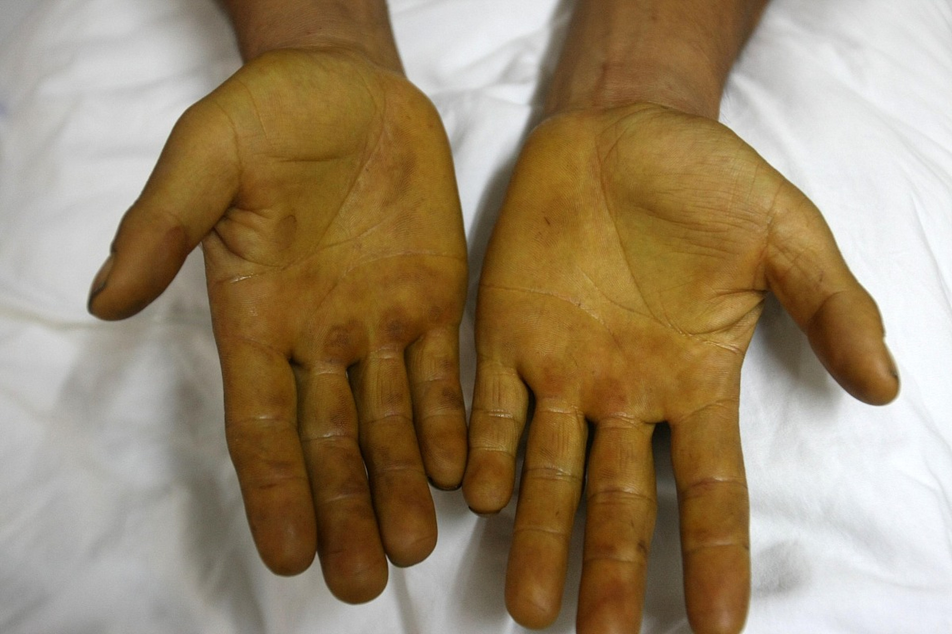 简单来说,肝掌是一种症状,具体表现为手掌大小鱼际