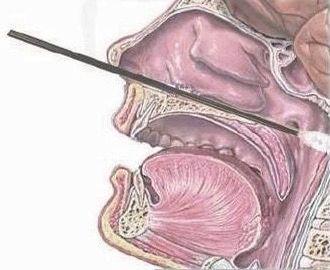 核酸检测咽拭子示意图图片
