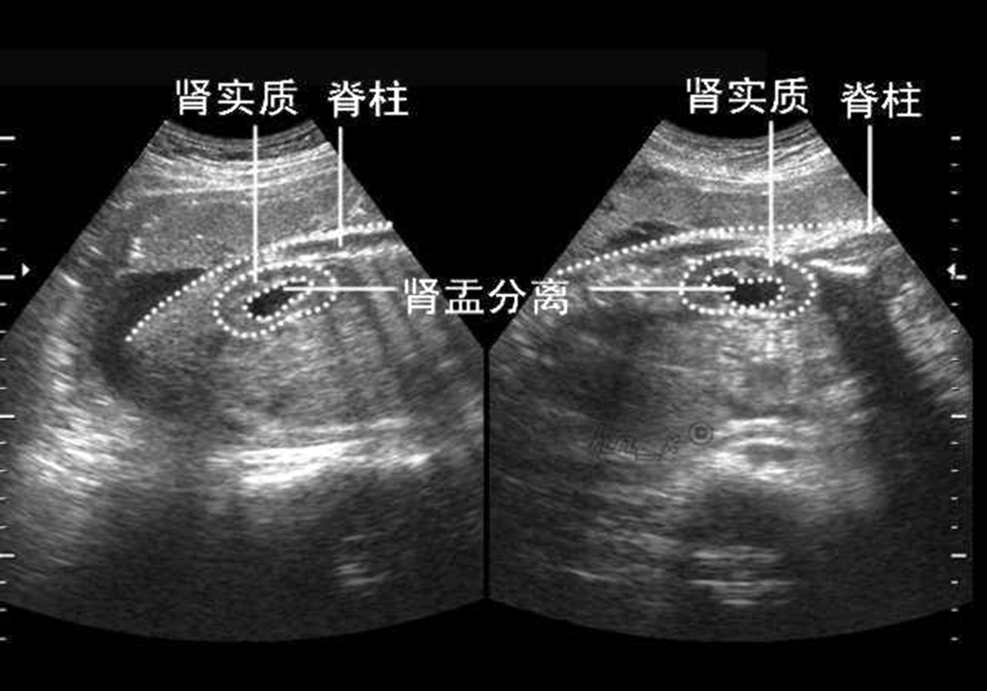 肾窦分离图片图片