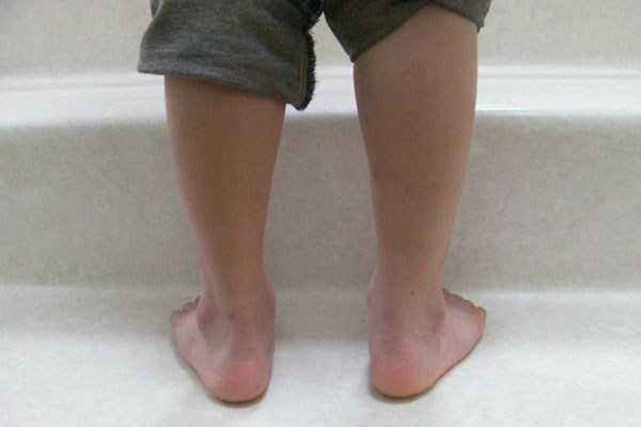 妈妈贪便宜,导致6岁孩子"双脚变形",医生:别给孩子穿这种鞋