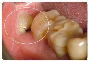 智齿必须要拔出来吗?若是这几种情况最好拔出来