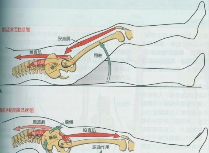 下交叉综合症矫正图解图片