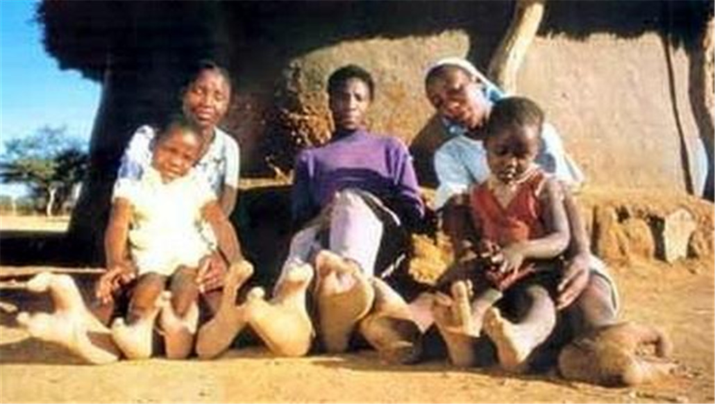 非洲一个神秘部落,被外界称为是鸵鸟人,他们天生只有两个脚趾头