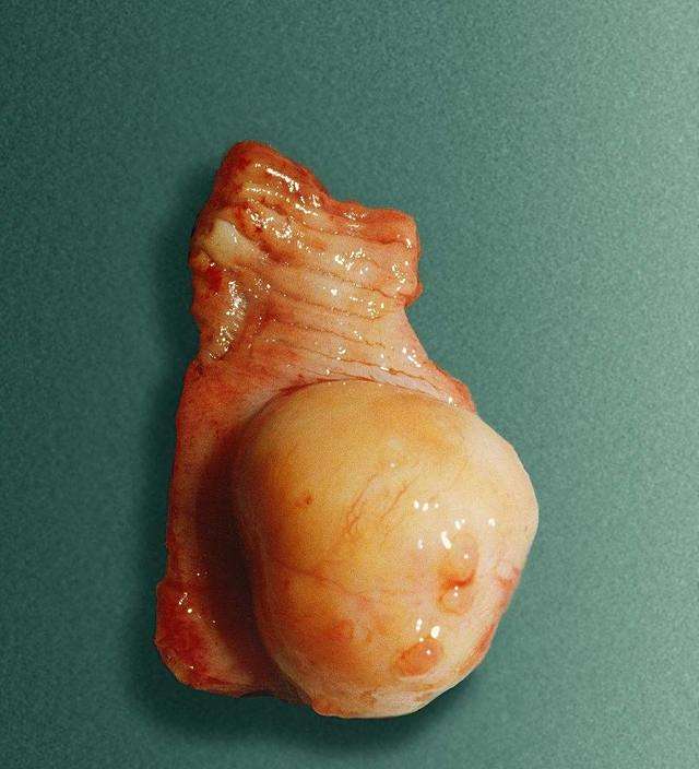 什么是脂肪瘤呢?脂肪瘤是常见的一种良性肿瘤!