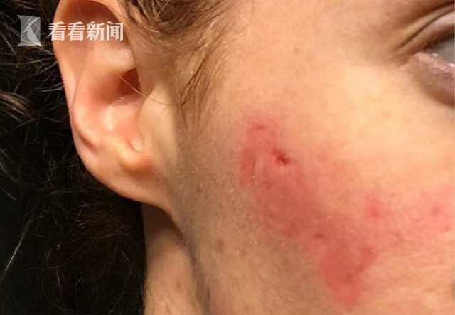 女子公厕用皂液洗手 脸部腐烂现坑洞如僵尸上脸