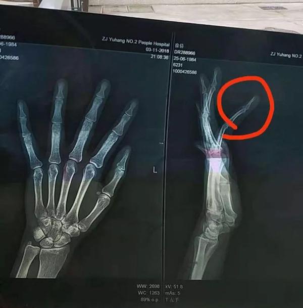 为保护孩子她用脚虚踢赶狗,结果遭狗主人殴打致左手无名指骨折