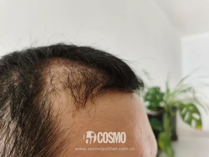 植发的男友(男子植发结果傻了眼)