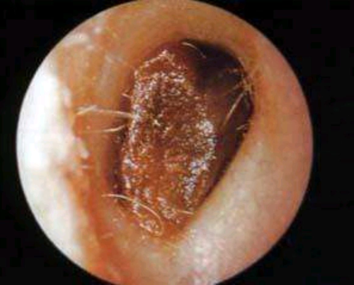 耳朵里面有硬耳塞子图图片