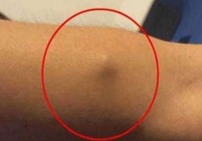 小伙手上长了一个包以为是肿瘤,取出的东西连医生都没想到